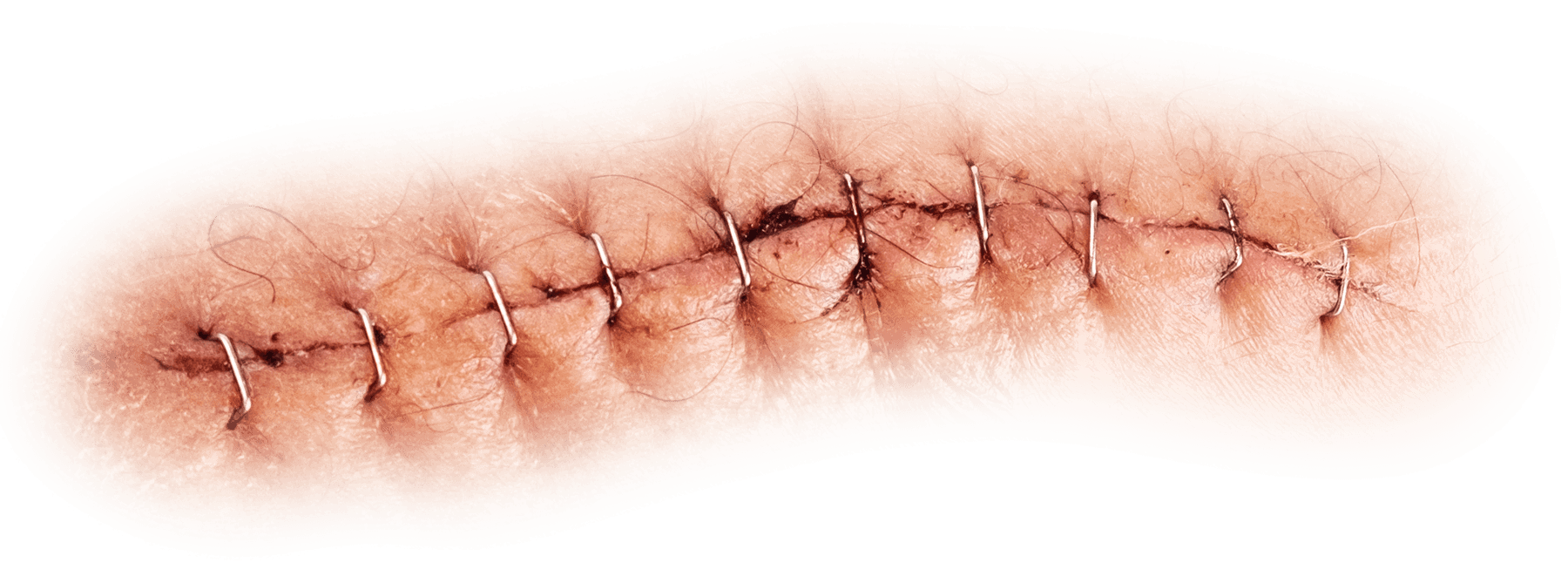 Stitches Image Transparent Background Stitches Image Transparent Background